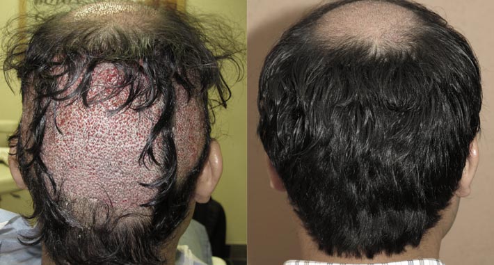 can you regrow dead hair follicles